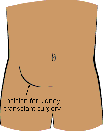 incision for kidney transplant